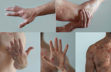 Collage of male body parts affected by blistering rash because of monkeypox or other viral infection