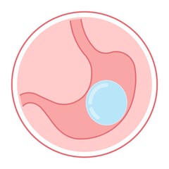 Gastric bypass surgery and Band roux en y procedure endoscopy weight loss hiatal hernia diet food full body mass index or BMI reflux GERD eat obese clinic tummy tuck small lap sleep apnea high blood