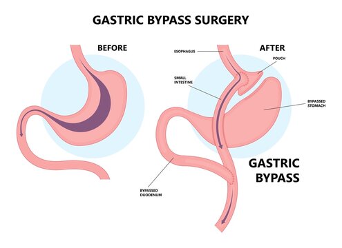 Gastric bypass surgery and Band roux en y procedure endoscopy weight loss hiatal hernia diet food full body mass index or BMI reflux GERD eat obese clinic tummy tuck small lap sleep apnea high blood