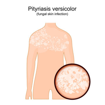 Tinea versicolor. Human body with symptoms of pityriasis versicolor.