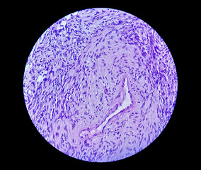 Photomicrograph of a schwannoma, a benign soft tissue tumor of peripheral nerve sheath.