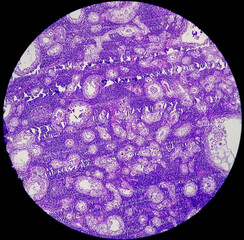 Stomach cancer: Adenocarcinoma of stomach, antrum cancer. High grade acute Inflammation near the tumor nests. Microscopic view.