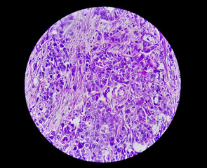 Stomach cancer: Adenocarcinoma of stomach, antrum cancer. High grade acute Inflammation near the...