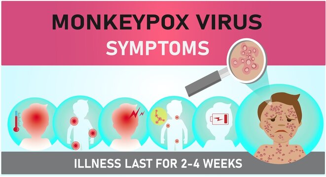 Monkeypox virus symptoms. Monkeypox symptoms infographics. Awareness of monkeypox virus. Cases of Monkeypox virus is spreading in the Europe and USA. Health care in USA and Europe. Vector illustration