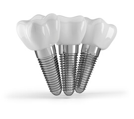 dental implants isolated on a white background.3D rendering