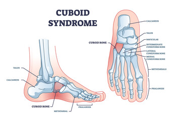 Cuboid syndrome as orthopedic trauma after foot torn injury outline diagram. Labeled educational scheme with feet bone dislocation and free movement vector illustration. Cuboid subluxation problem.