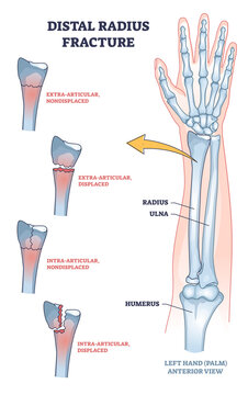 Distal radius fracture and broken arm bone types anatomy outline diagram. Labeled educational scheme with extra articular nondisplaced and displaced radius and ulna comparison vector illustration.