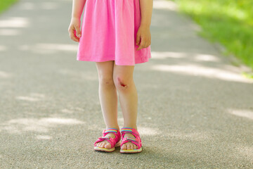 Toddler girl with abrasion knee skin standing on asphalt sidewalk at city park in summer day. Child after fell down. Closeup. Front view.