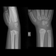 growth plate fracture on hand and leg x ray image