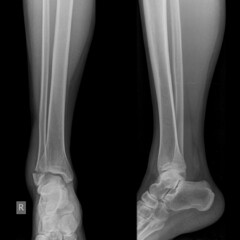 growth plate fracture on hand and leg x ray image