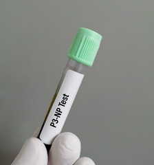 Fototapeta na wymiar Blood sample for P3-NP or Type III procollagen peptide test, to diagnose hepatic fibrosis. liver disease.