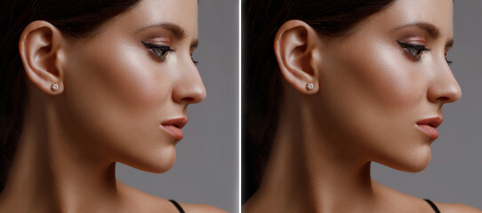 rhinoplasty before and after correction, young girl in profile