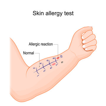 Skin allergy test. Human arm with allergen.