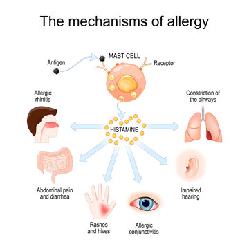 Mechanism of allergy. Mast cells and allergic reaction. Histamine.