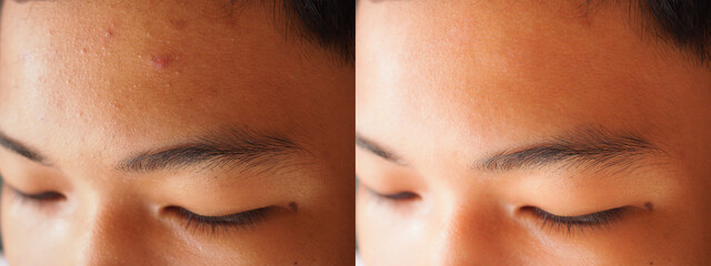Image before and after acne treatment on the face of young asian man .Problem skin and beauty...