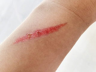 Close up of burn scar on a woman's hand. The skin damage in first-degree on outer layer skin....