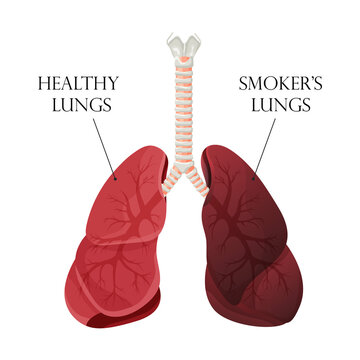 Illustration of normal healthy lungs and lungs smoker. Concept of stop smoking. Vector illustration.