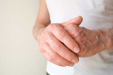 Close up of male hands with dry skin damage, applying moisturizer. Dermatology concept human hands with skin with cracks and wounds, skin treatment, aging hand skin care