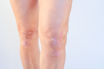 Knee joint effusion ( water on the knee).Acute psoriatic arthritis, arthrosis ,meniscus...
