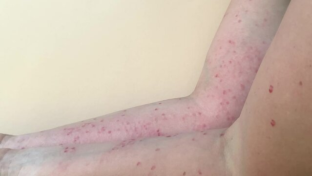 Close-up of women's hands on a beige background, covered with ulcers, pimples, blisters and sores. Patient with Painful rash, red spots blisters on the hand. Monkey Pox.
