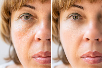 Woman With Before And After Rejuvenation