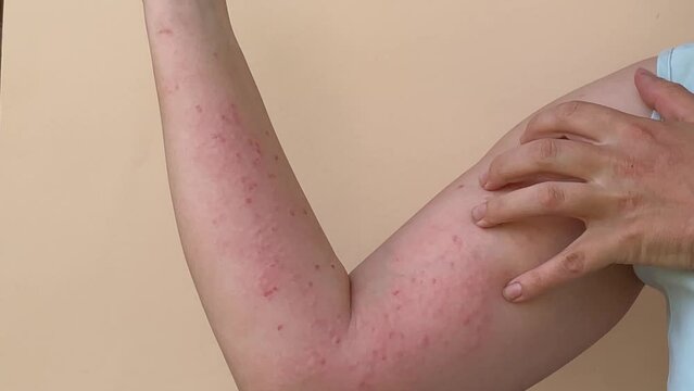 Close-up of women's hands on a beige background, covered with ulcers, pimples, blisters and sores. Patient with Painful rash, red spots blisters on the hand. Monkey Pox.