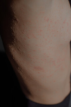 Allergic Skin Eruption Body Part 
