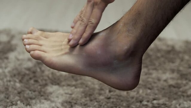 Close-up of a man's hand touches his foot with a big bruise at home, sprain and injury