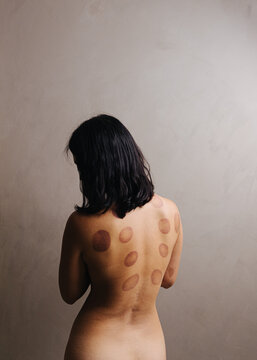 Bare ack covered in cupping marks