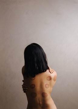 Bare back covered in cupping marks