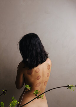 Bare Back Covered In Cupping Marks