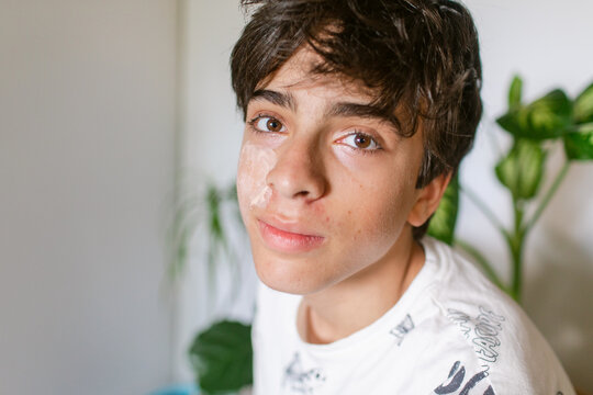 Teen boy with acne treatment  on face looking at camera