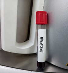 Test tube with sample for EBV Ab VCA IgG test, to diagnosis infectious mononucleosis.