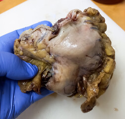 Resected lower part of stomach at laboratory for biopsy. Gastric biopsies.