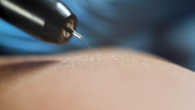 The process of permanently removing unwanted hair using an electric epilator and tweezers by a professional beautician in gloves. Spa, beauty industry, clinic treatment.
