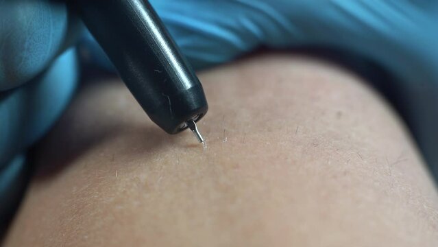 dermatologist performs a hair removal procedure on a patient's leg using electrolysis. Depilation and beauty concept. The doctor works in a cosmetic medical office. permanent hair removal
