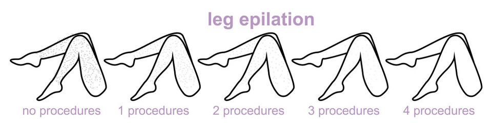 legs epilation, number of procedures, hair removal, women's legs, stages of laser hair removal of legs completely, smooth skin