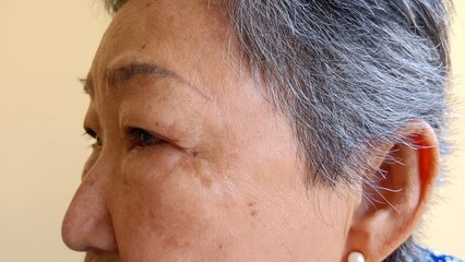 An old woman has wrinkles on her face.