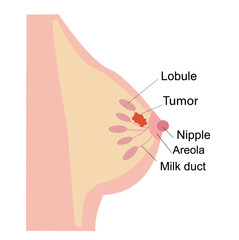 Obraz premium Infographic, medical flat illustration of female breast cancer. A tumor or neoplasm in the human chest. Anatomy of the nipple, lobule, duct and in female silhouette. Illustration for clinic, education