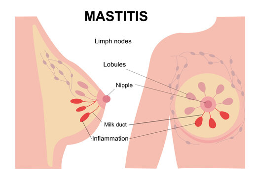 Infographic, medical flat illustration of mastitis and female breast disease concept.  Pain and inflammation in woman chest. Anatomy of the nipple, lobule, duct and in female silhouette. 