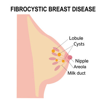 Infographic, medical flat illustration of fibrocystic breast disease and female cancer concept.  Pain, tumor or neoplasm in human chest. Anatomy of the nipple, lobule, duct and in female silhouette. 