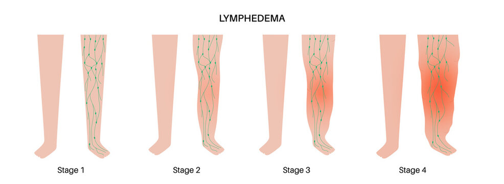 Stages of lymphedema