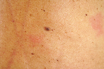 Fototapeta premium Moles on the back of human skin