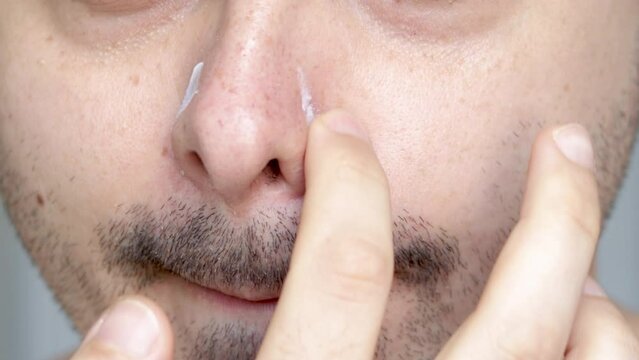 man with seborrheic dermatitis around the nose area is applying cream,treatment,medical concept,doctor's recommendation.young man with finger putting white face lotion,moisturizing