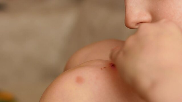 Caucasian boy 6-7 years old blows on a bloody abrasion on his knee. The boy hit his knee and got a scratch examines and touches the sore.Selective focus