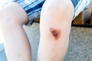 Abrasions, bruises on the knees of unrecognizable teenager. Life of teenagers, injuries, danger