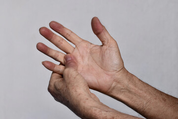 Cyanotic hands or peripheral cyanosis or blue hands at Asian man