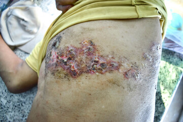Herpes simplex infection at chest and abdomen. - obrazy, fototapety, plakaty