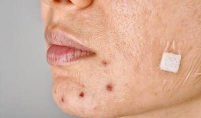 Facial skin problem, Acne disease in adult, Close up woman face with whitehead pimples, Oily greasy...
