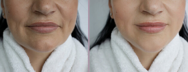 Woman double chin before and after treatment